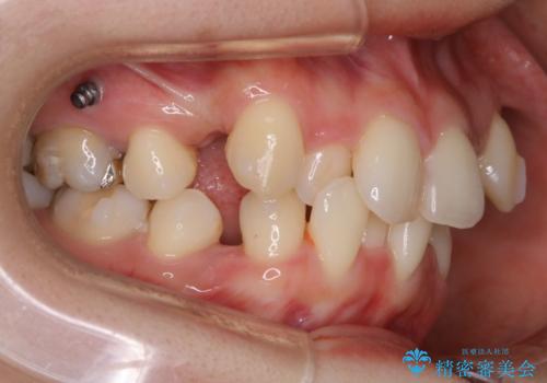 【抜歯】前歯のガタつきを改善　抜歯矯正で口腔内をスッキリさせるの治療中