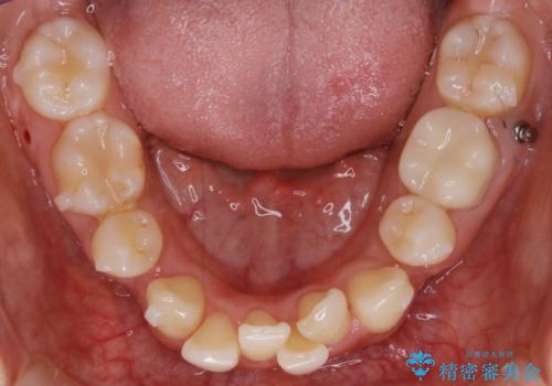 【抜歯】前歯のガタつきを改善　抜歯矯正で口腔内をスッキリさせるの治療中
