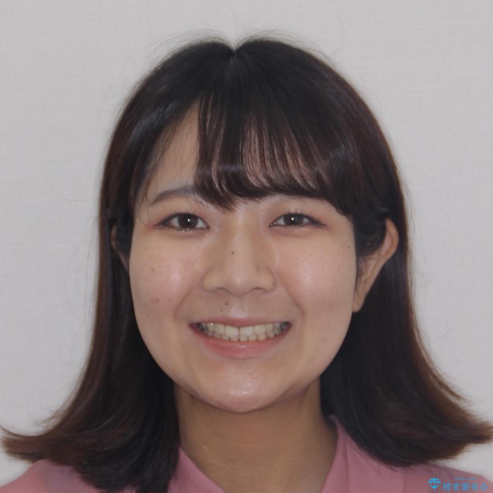 【モニター】舌のトレーニングを行いながら後戻りの再矯正の治療後(顔貌)