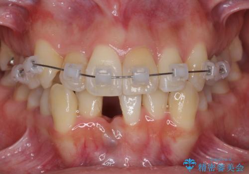 歯のがたつき　4本抜歯を回避してマウスピース矯正への治療中
