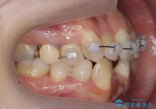 歯のがたつき　4本抜歯を回避してマウスピース矯正への治療中