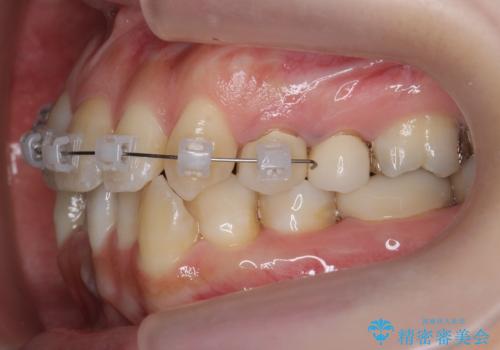 歯のがたつき 4本抜歯を回避してマウスピース矯正への治療中