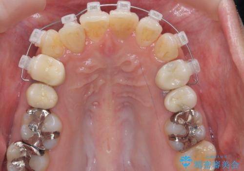 歯のがたつき 4本抜歯を回避してマウスピース矯正への治療中