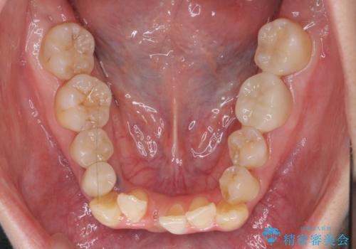 歯のがたつき 4本抜歯を回避してマウスピース矯正への治療中