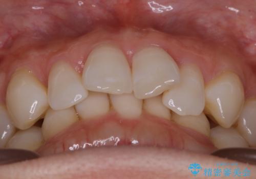 【抜歯】矯正治療とインプラントで正常な噛み合わせを実現の治療前