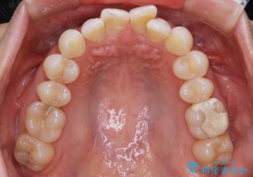 【抜歯】矯正治療とインプラントで正常な噛み合わせを実現の治療前