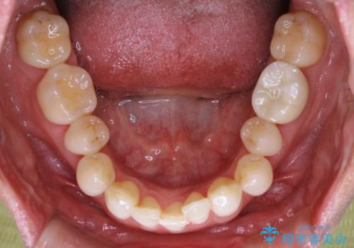 【抜歯】矯正治療とインプラントで正常な噛み合わせを実現の治療前