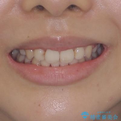 八重歯と乱れた咬み合わせを改善 ワイヤー装置での抜歯矯正の治療後(顔貌)