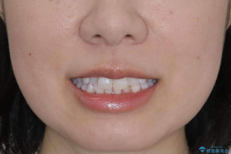 【非抜歯】歯軸を治して正しい噛み合わせへの治療前（顔貌）