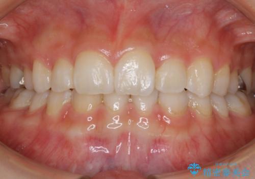 【抜歯】歯の先天欠如　歯の本数が上下で違う場合の治療の症例 治療後