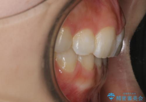 【抜歯】歯の先天欠如　歯の本数が上下で違う場合の治療の治療後