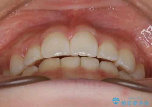 【抜歯】歯の先天欠如 歯の本数が上下で違う場合の治療の治療後