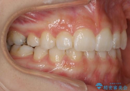 【抜歯】歯の先天欠如 歯の本数が上下で違う場合の治療の治療後
