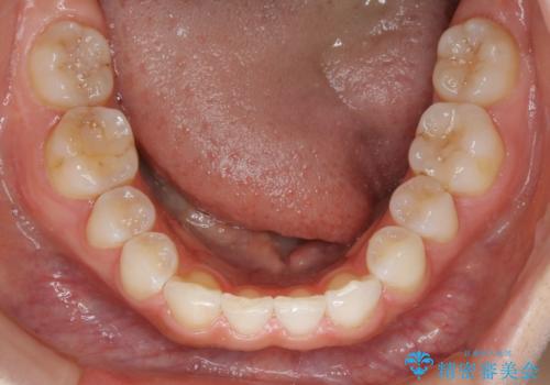 【抜歯】歯の先天欠如　歯の本数が上下で違う場合の治療の治療後