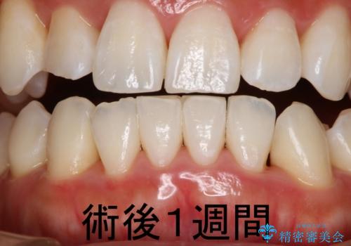 矯正後の歯肉のブラックトライアングルを改善!の症例 治療後