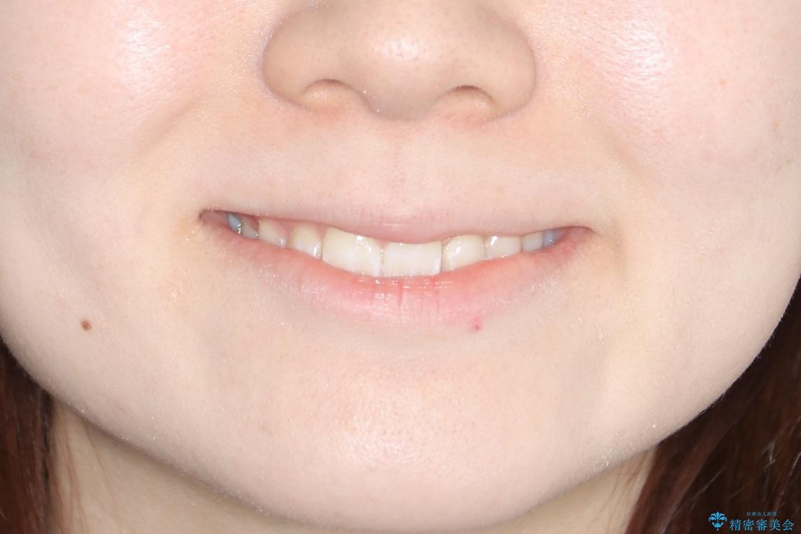 【抜歯】歯の先天欠如　歯の本数が上下で違う場合の治療の治療後（顔貌）