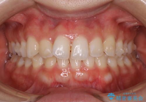 【非抜歯】下の前歯が1本少ない場合の矯正治療の治療中