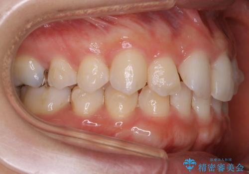 【非抜歯】下の前歯が1本少ない場合の矯正治療の治療中