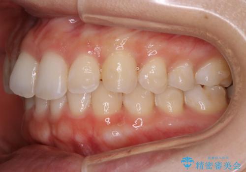 【非抜歯】下の前歯が1本少ない場合の矯正治療の治療中