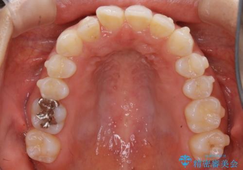 【非抜歯】下の前歯が1本少ない場合の矯正治療の治療中