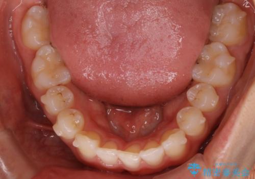 【非抜歯】下の前歯が1本少ない場合の矯正治療の治療中