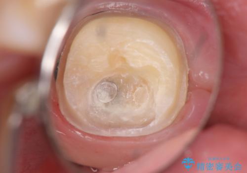 奥歯がしみる 神経を温存する治療の治療中