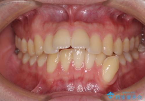 出っ歯と八重歯　目立たない裏側装置でスッキリとした口元にの症例 治療前