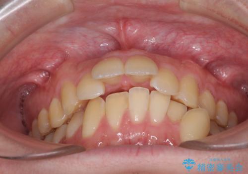 出っ歯と八重歯 目立たない裏側装置でスッキリとした口元にの治療前