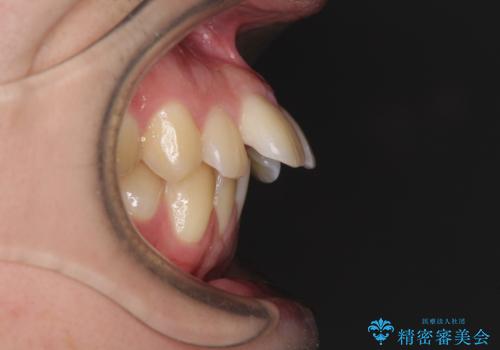 出っ歯と八重歯 目立たない裏側装置でスッキリとした口元にの治療前