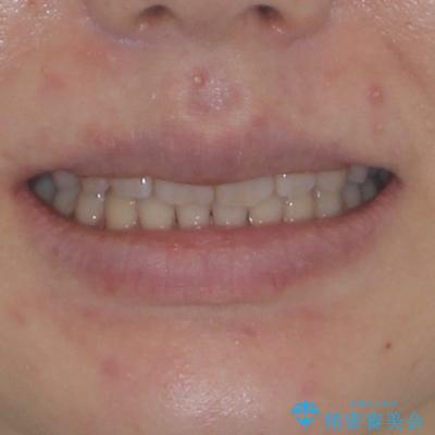 手間をかけずに治したい 短期間のワイヤー矯正の治療後(顔貌)