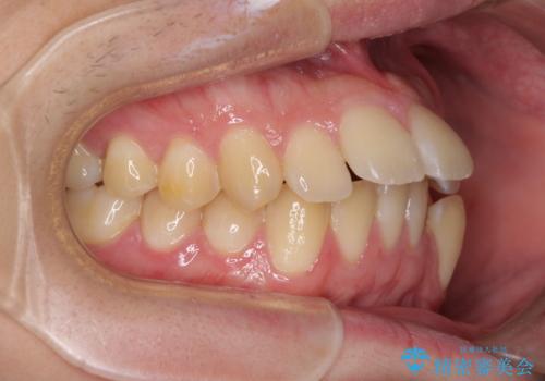 出っ歯と八重歯 目立たない裏側装置でスッキリとした口元にの治療前