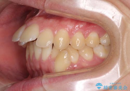 出っ歯と八重歯 目立たない裏側装置でスッキリとした口元にの治療前