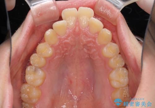 出っ歯と八重歯　目立たない裏側装置でスッキリとした口元にの治療前