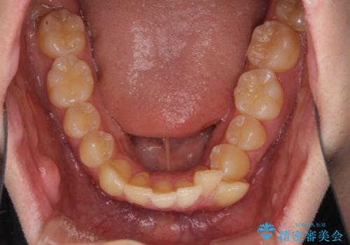 出っ歯と八重歯 目立たない裏側装置でスッキリとした口元にの治療前