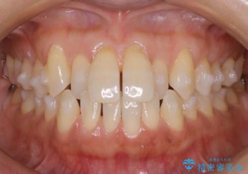 【非抜歯】短期間で実現する前歯の反対咬合治療の治療中