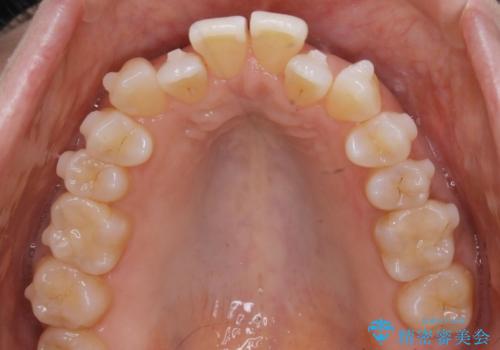 【非抜歯】短期間で実現する前歯の反対咬合治療の治療中