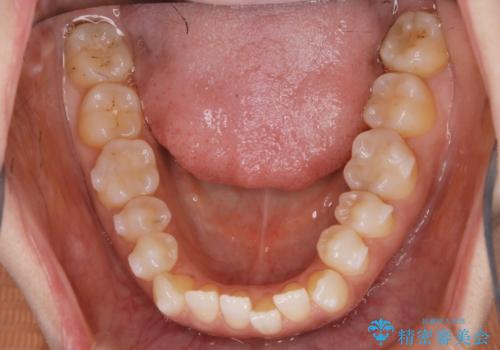 【非抜歯】短期間で実現する前歯の反対咬合治療の治療中