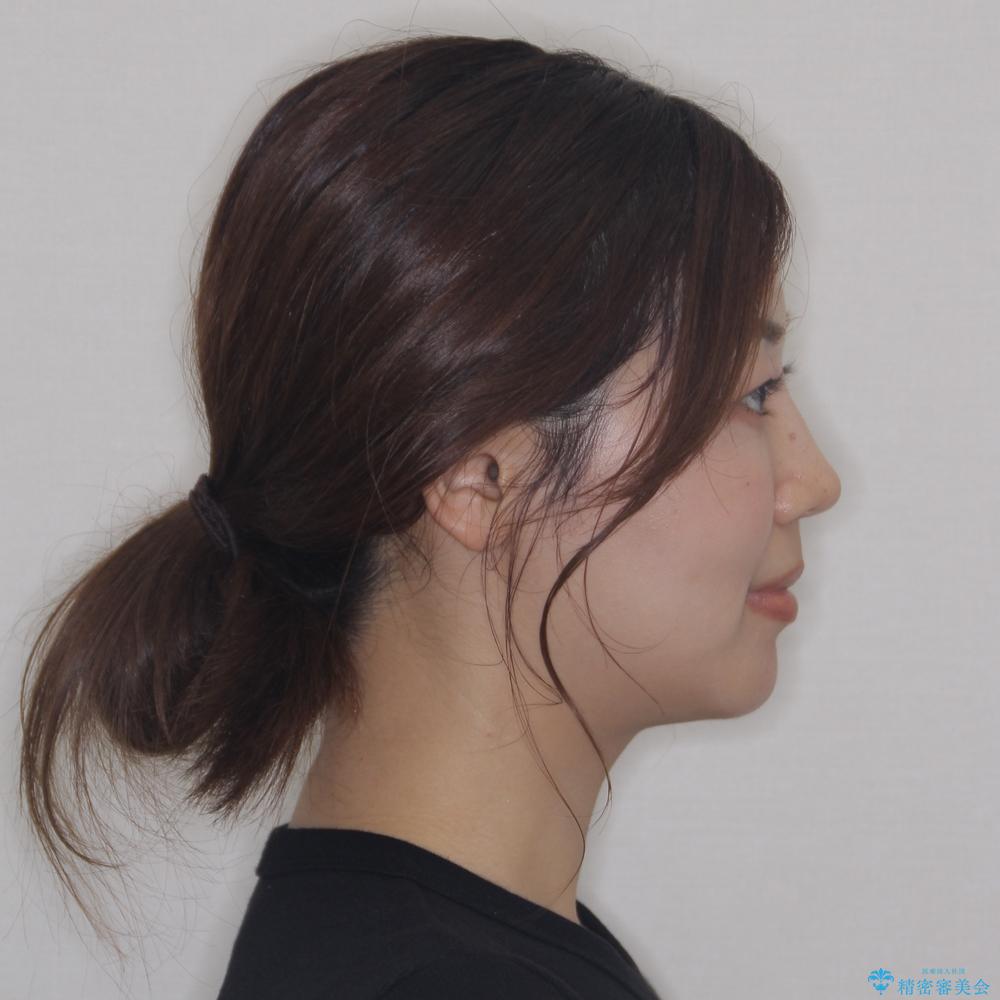 【モニター】横顔のシルエットをスッキリと ワイヤー装置による抜歯矯正治療の治療後(顔貌)