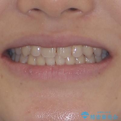 深い咬み合わせとデコボコの歯列をワイヤー矯正で改善の治療後（顔貌）