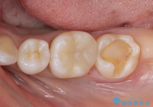 メタルの詰め物が取れたの治療中