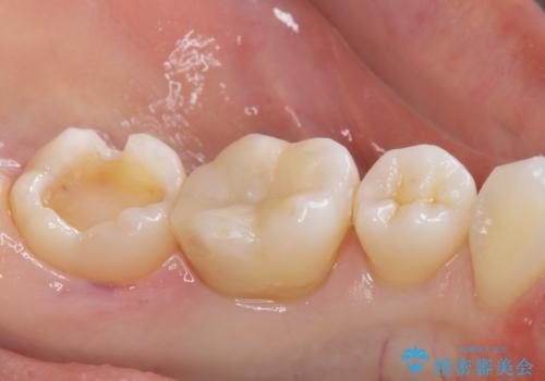 メタルの詰め物が取れたの治療中