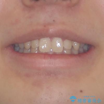 欠損した前歯とディープバイト　ワイヤー矯正で短期間で治療の治療前（顔貌）