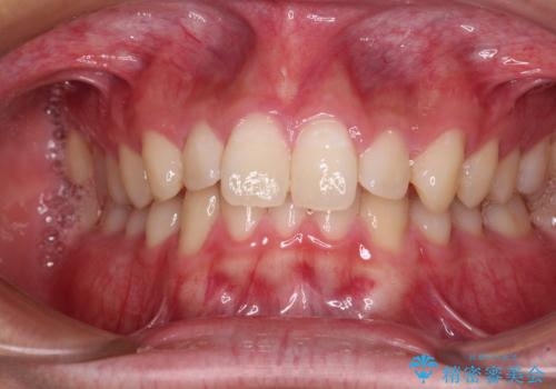 欠損した前歯とディープバイト　ワイヤー矯正で短期間で治療の症例 治療前