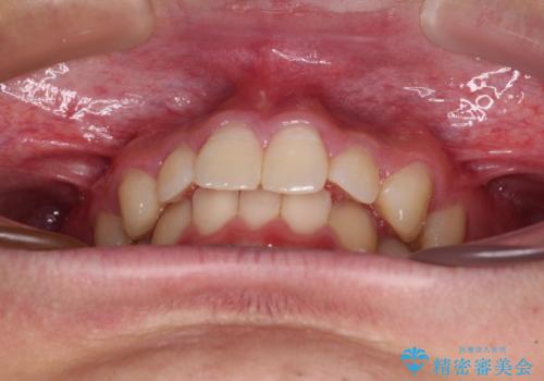 欠損した前歯とディープバイト ワイヤー矯正で短期間で治療の治療前