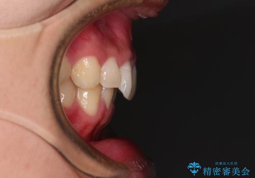 欠損した前歯とディープバイト ワイヤー矯正で短期間で治療の治療前