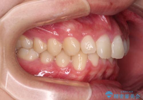 欠損した前歯とディープバイト　ワイヤー矯正で短期間で治療の治療前