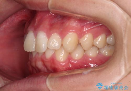 欠損した前歯とディープバイト ワイヤー矯正で短期間で治療の治療前