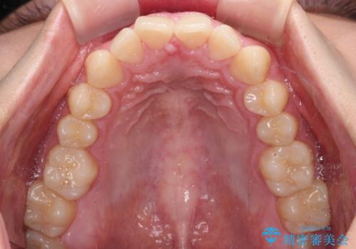 欠損した前歯とディープバイト ワイヤー矯正で短期間で治療の治療前