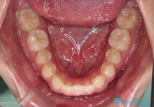 欠損した前歯とディープバイト　ワイヤー矯正で短期間で治療の治療前