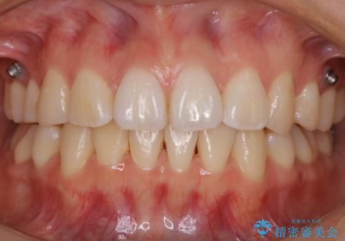 【再矯正】後戻りによるガタつきをマウスピースで改善!